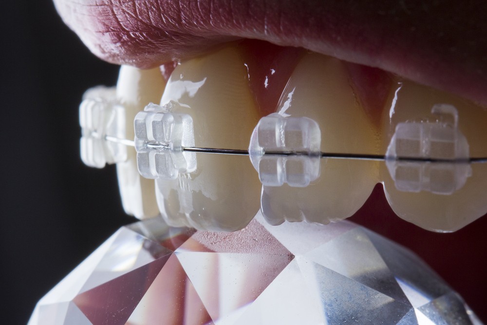 aparat dentar bucuresti, ortodontie bucuresti, clinica stomatologica orto care