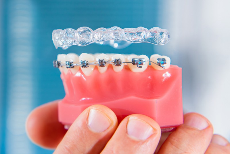 Avantajele și dezavantajele diferitelor tipuri de aparate dentare disponibile la OrtoCare.