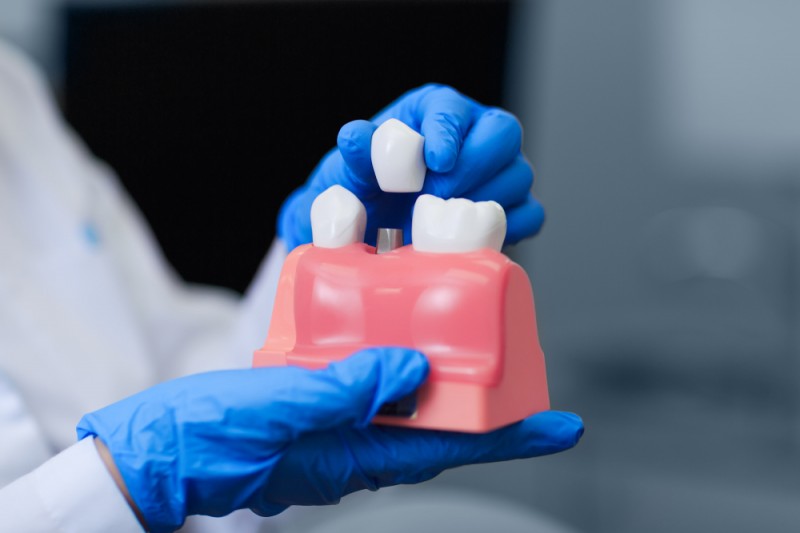 Realitatea implanturilor dentare: 4 mituri pe care trebuie să le știți