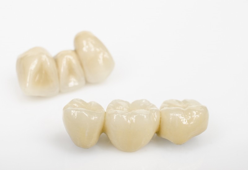 Coroanele din ceramică presată nu se montează pe structuri de susţinere metalice.