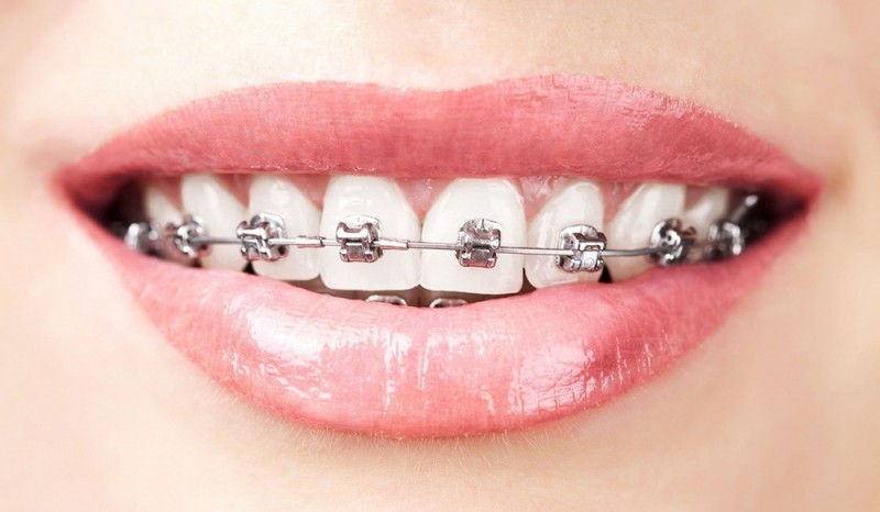 Din ce sunt alcătuite şi cum se îngrijesc aparatele dentare metalice?