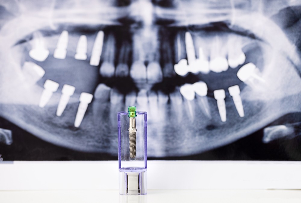 Implant dentar