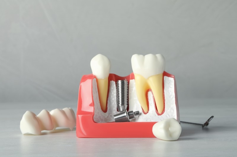 Te-ai gândit vreodată cât de important este tratamentul cu implant dentar?
