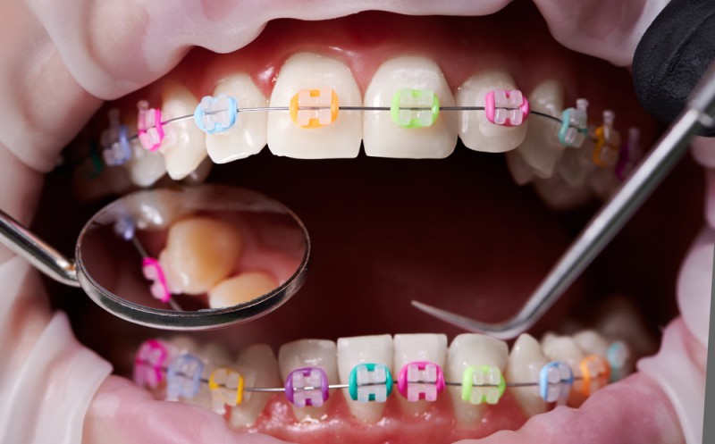 Aparat dentar fix sau mobil? Care este cea mai bună opțiune pentru tine? Sfatul experților de la Ort