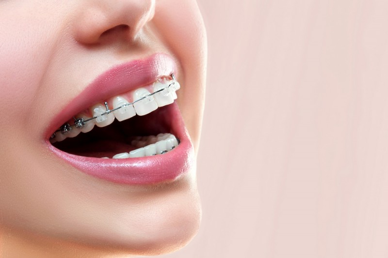 Aparatele dentare ceramice – sau estetica ce susţine funcţionalitatea