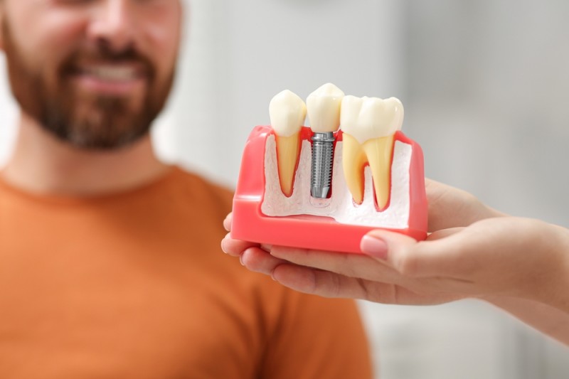 Implant dentar - Miturile care ne influentează decizia