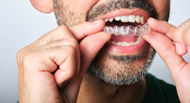 Aparat dentar pentru adulți: De ce nu este niciodată prea târziu pentru a corecta problemele dentare