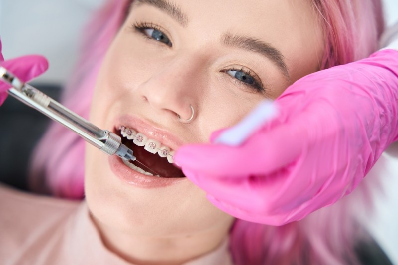 Cât de des trebuie să vizitez clinica după aplicarea aparatului dentar? Programul de la Orto Care