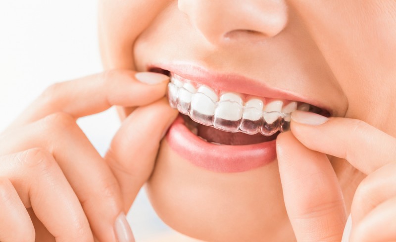 Avantajele tratamentului cu aparat dentar invizibil
