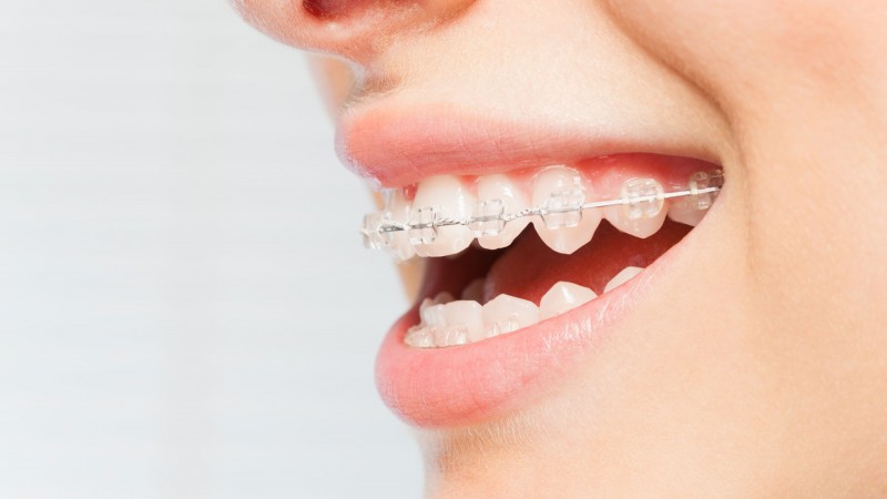 Aparat dentar ceramic - o tehnologie nouă, un zâmbet nou!