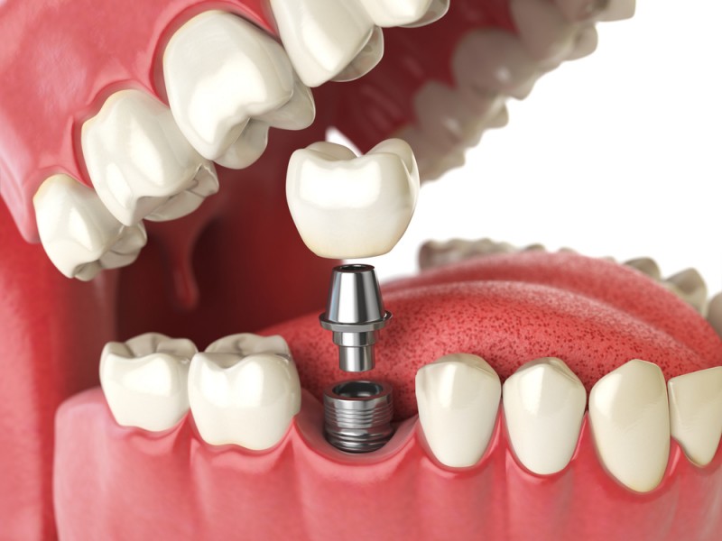 Ce este un implant dentar? Un ghid pentru toți pacienții