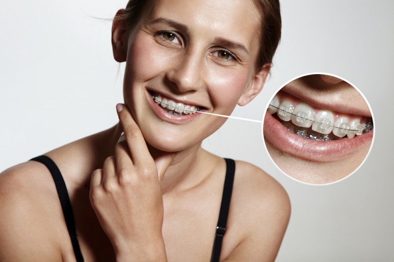 Cum pot reduce disconfortul în timpul tratamentului cu aparat dentar la Orto Care?