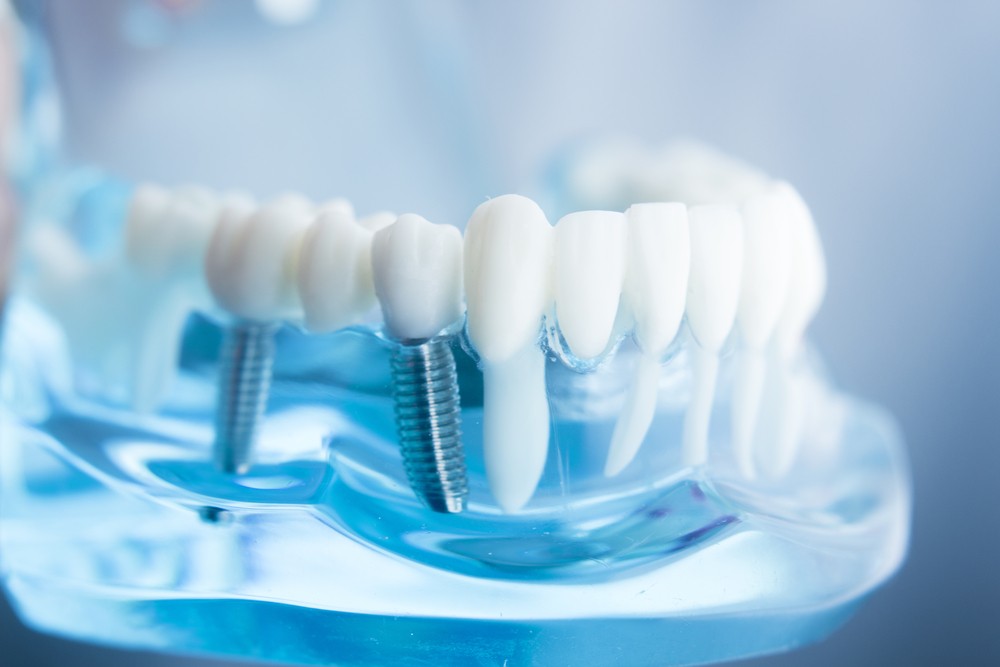 implant dentar