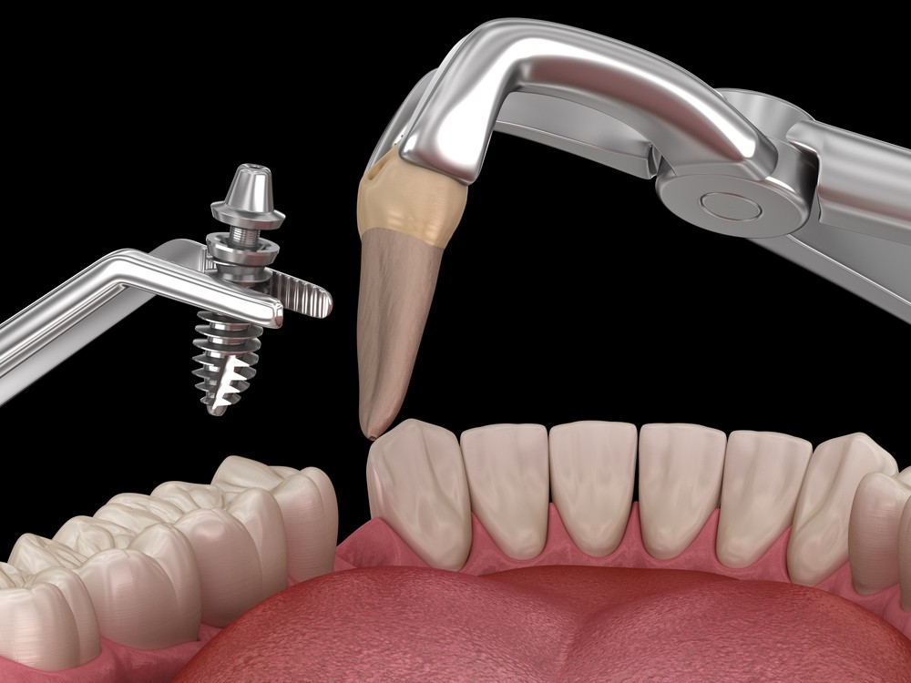 implant dentar bucuresti, clinica stomatologica orto care bucuresti