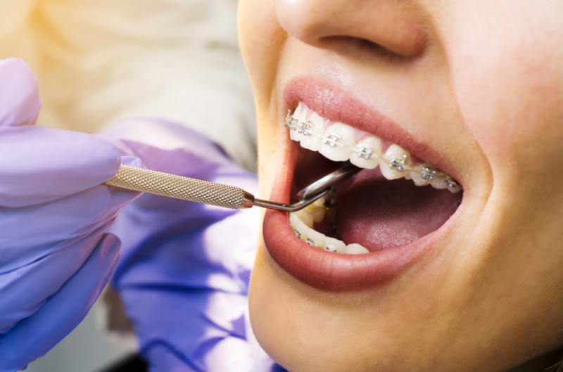 De ce amânarea tratamentului cu aparat dentar poate avea consecințe negative pentru sănătatea ta