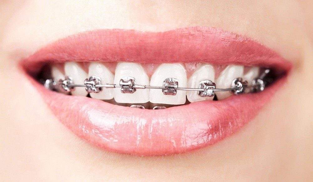 aparat dentar metalic, orto care, aparat dentar metalic bucuresti, aparat dentar metalic calea vitan