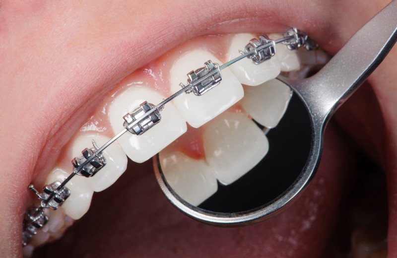 Aparatele dentare metalice nu realizează doar îndreptarea efectivă a dinţilor, ci mai multe lucruri