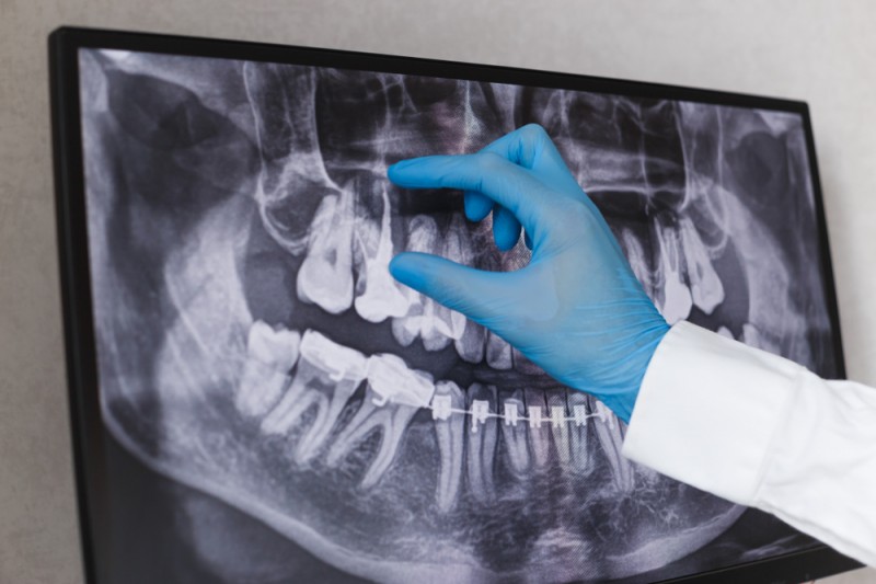 De ce este atât de importantă o radiografie dentară înaintea începerii tratamentului ortodontic?