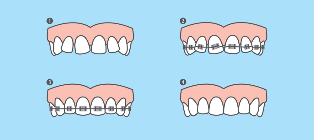 aparat dentar bucuresti, clinica stomatologica orto care bucuresti