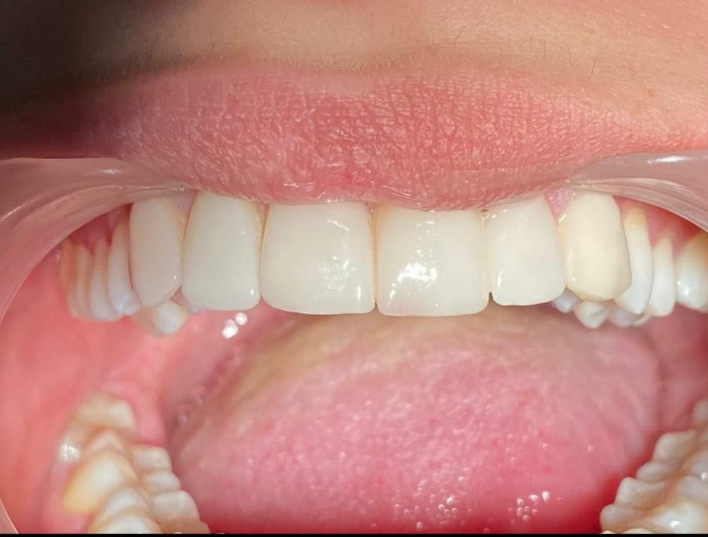 Caz 11 - Estetică + protetică dentară