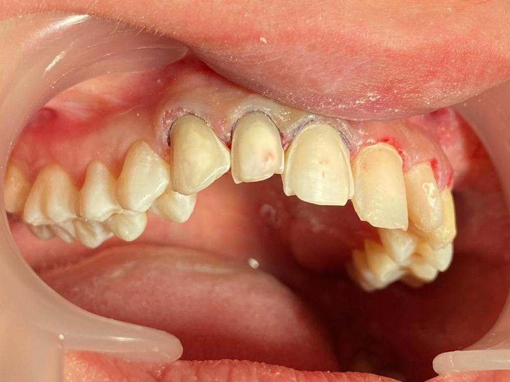 Caz 11 - Estetică + protetică dentară