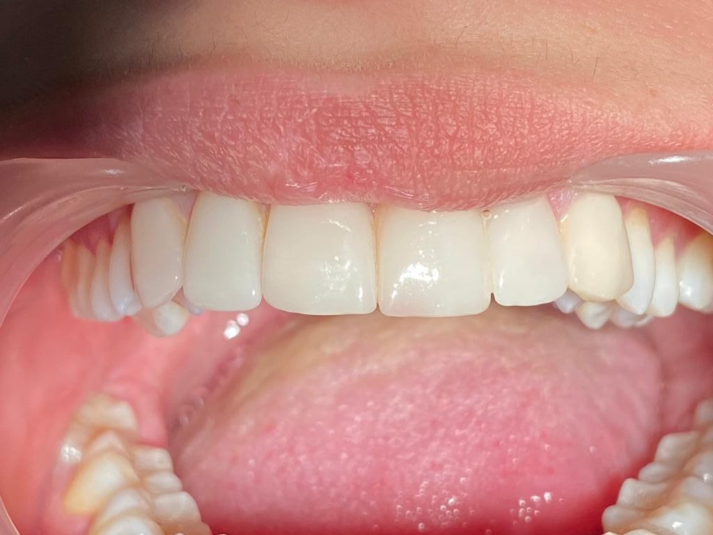 Caz 11 - Estetică + protetică dentară