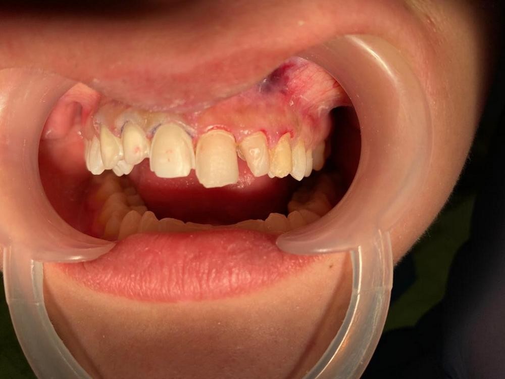 Caz 11 - Estetică + protetică dentară