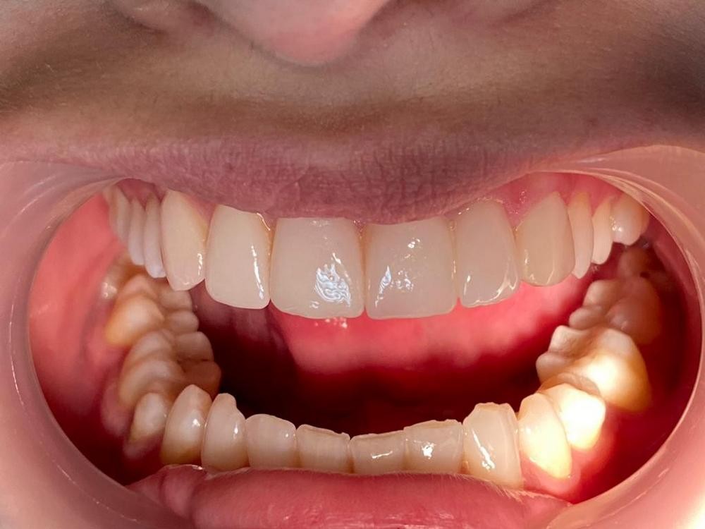 Caz 11 - Estetică + protetică dentară