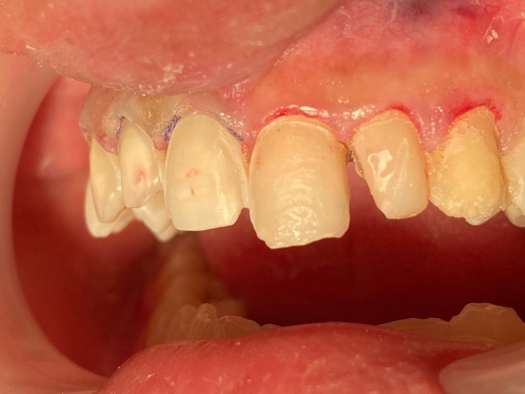 Caz 11 - Estetică + protetică dentară