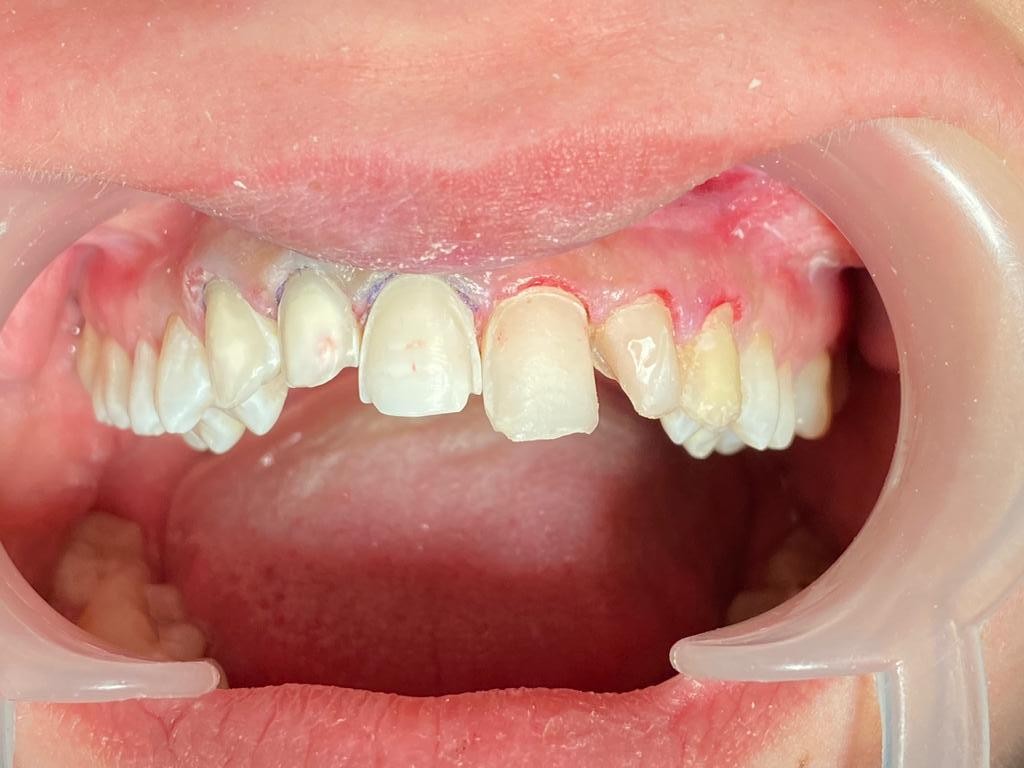 Caz 11 - Estetică + protetică dentară