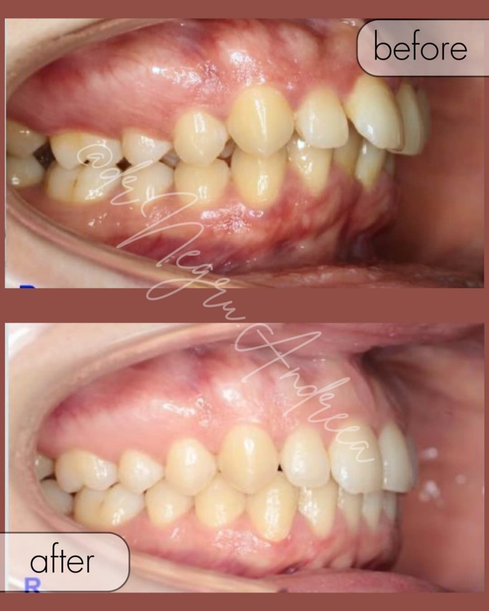 Caz 1 - Ortodontie