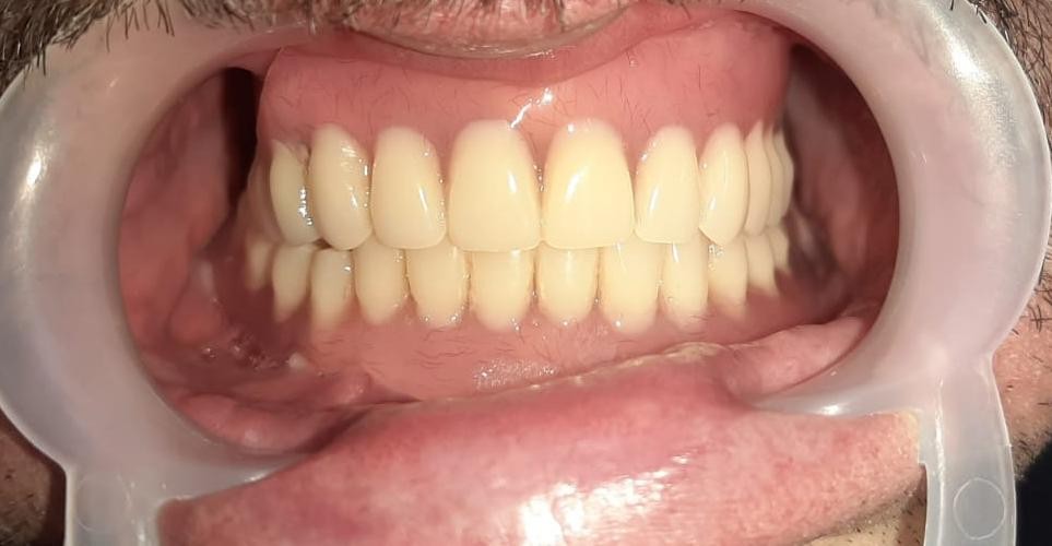 Caz 10 - Protetică dentară