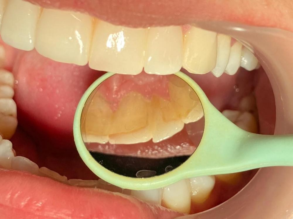 Caz 11 - Estetică + protetică dentară