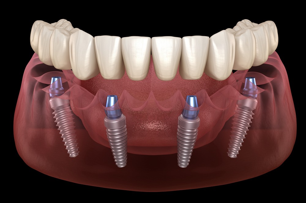 implant dentar, implant dentar bucuresti, implant dentar vitan, implant dentar orto care, pret impla