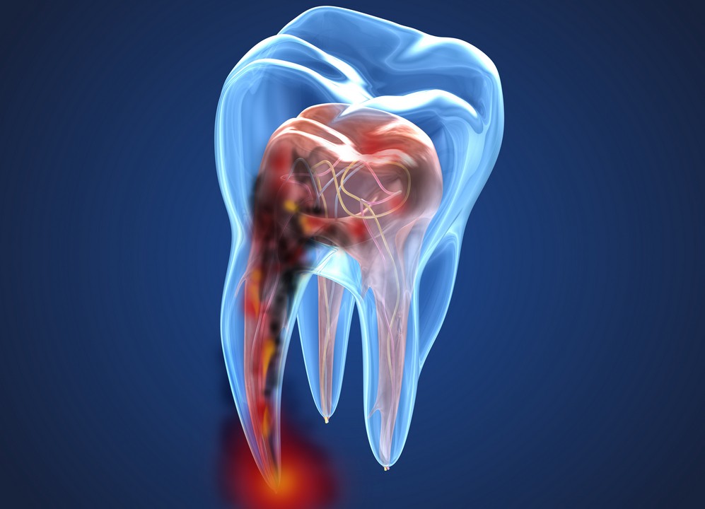 tratament endodontic, obturatie de canal, orto care, stomatologie bucuresti, stomatologie vitan