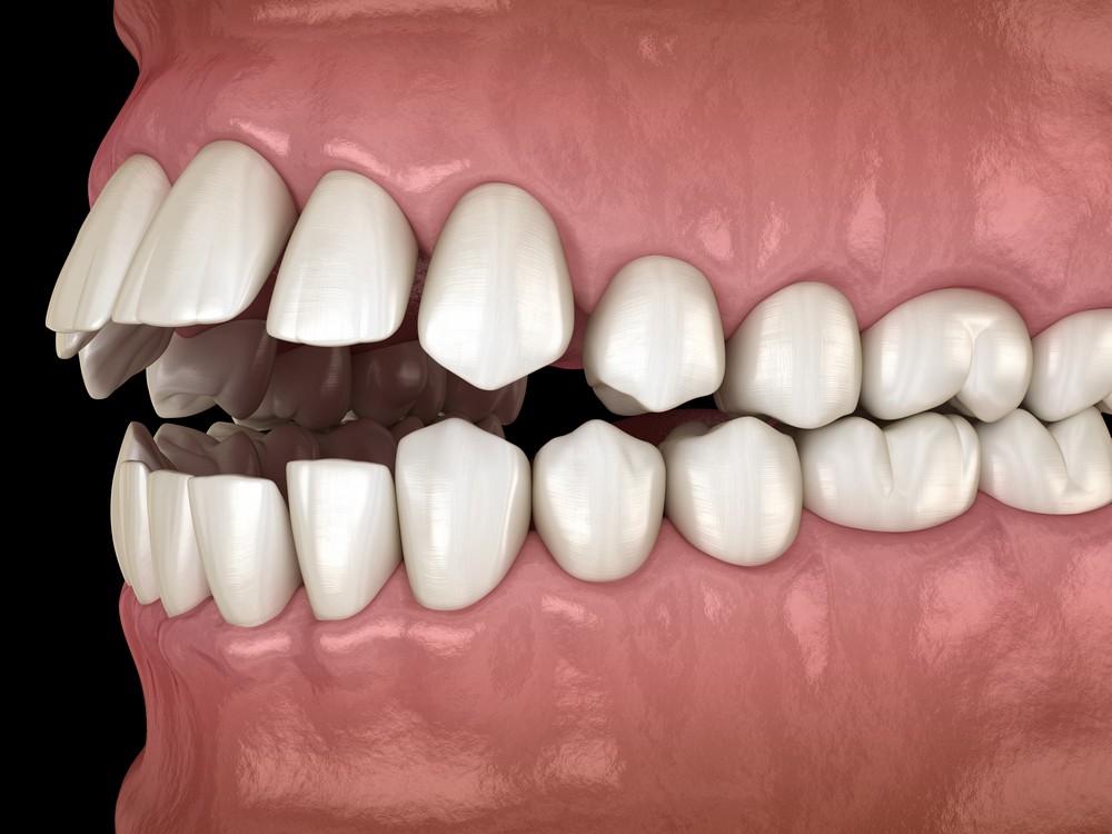aparat dentar bucuresti, aparat lingual bucuresti, aparat metalic bucuresti, ortodontie bucuresti