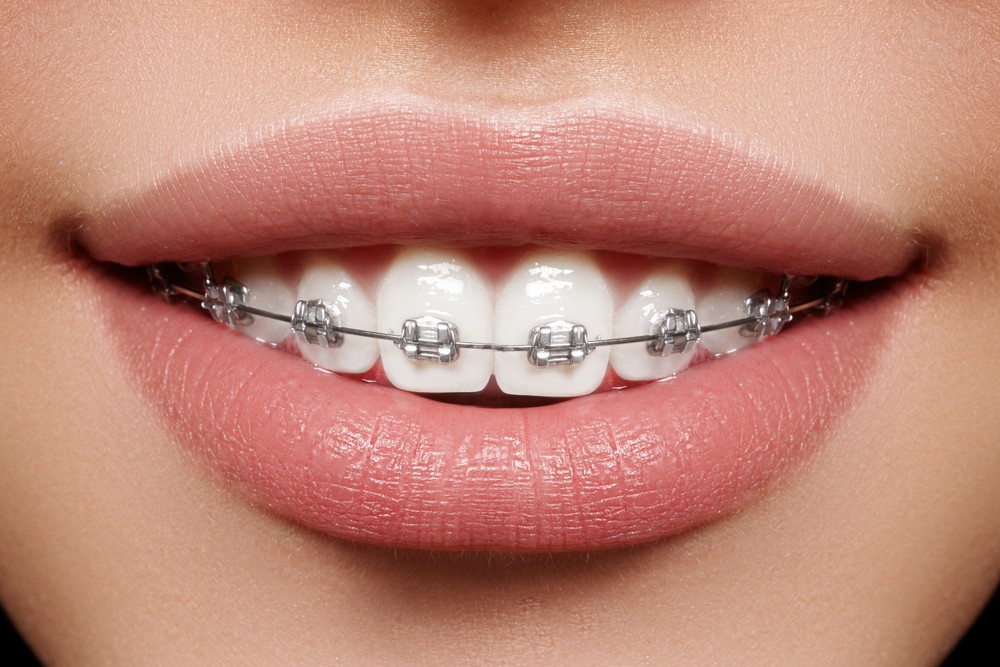 aparat dentar lingual bucuresti, aparat dentar bucuresti, aparat dentar metalic bucuresti