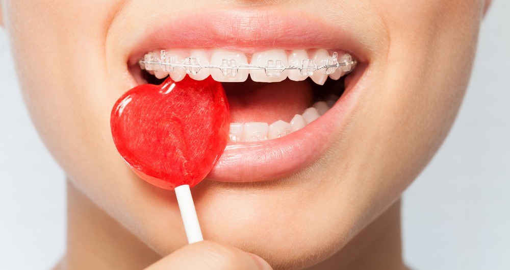 orto care, aparat dentar bucuresti, aparat metalic bucuresti, aparat lingual bucuresti, ortodontie b