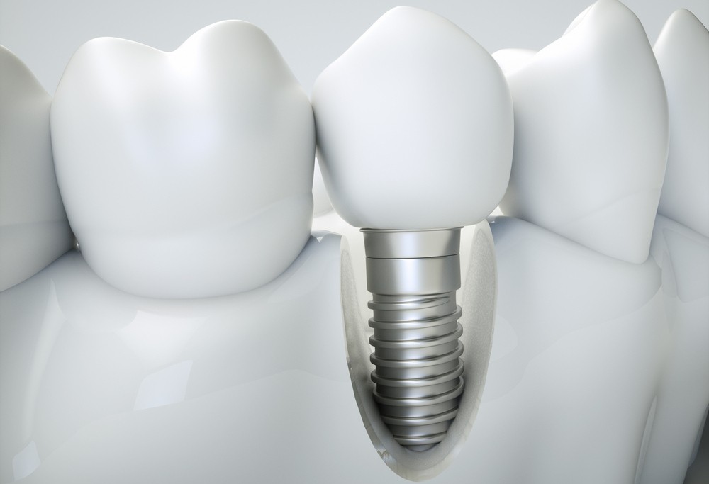 implant dentar, implant dentar bucuresti, implant dentar vitan, implant dentar orto care, pret impla