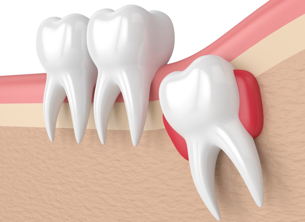 extractie masea de mintebucuresti, extractie molar de minte bucuresti, orto care