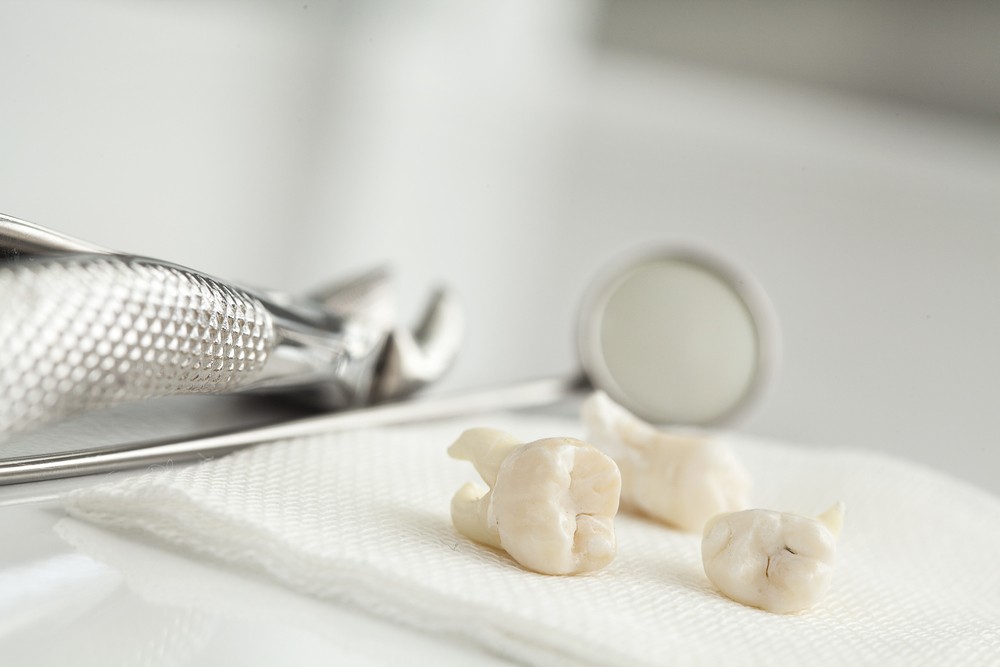 extractie masea de mintebucuresti, extractie molar de minte bucuresti, orto care