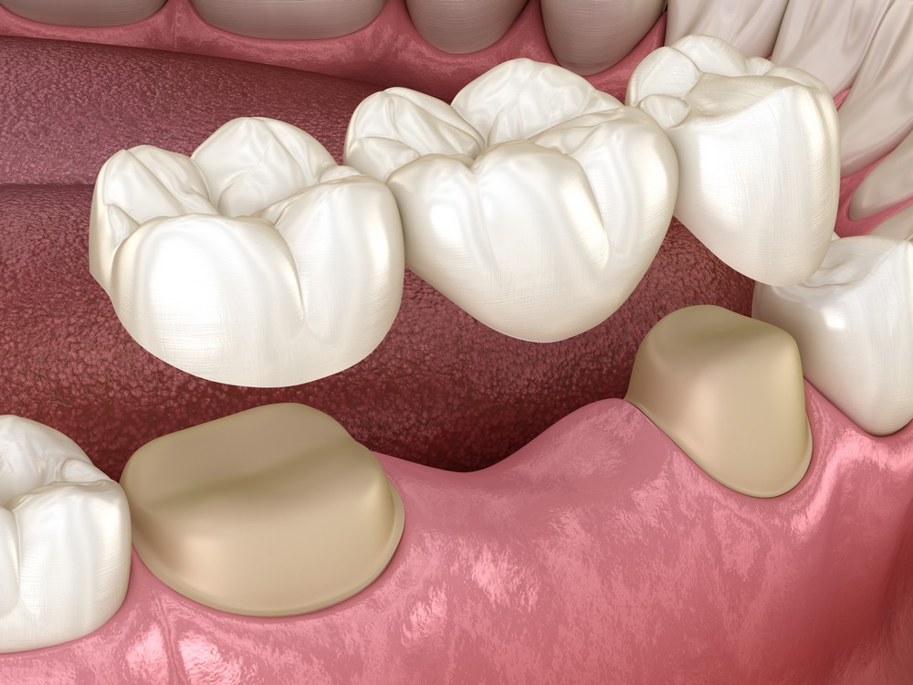 protetica dentara orto care, coroane dentare, coroane dentare bucresti, protetica dentara bucuresti