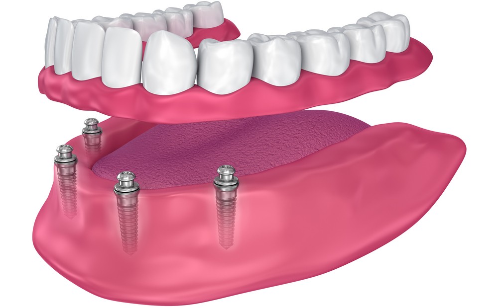 protetica dentara orto care, coroane dentare, coroane dentare bucresti, protetica dentara bucuresti,