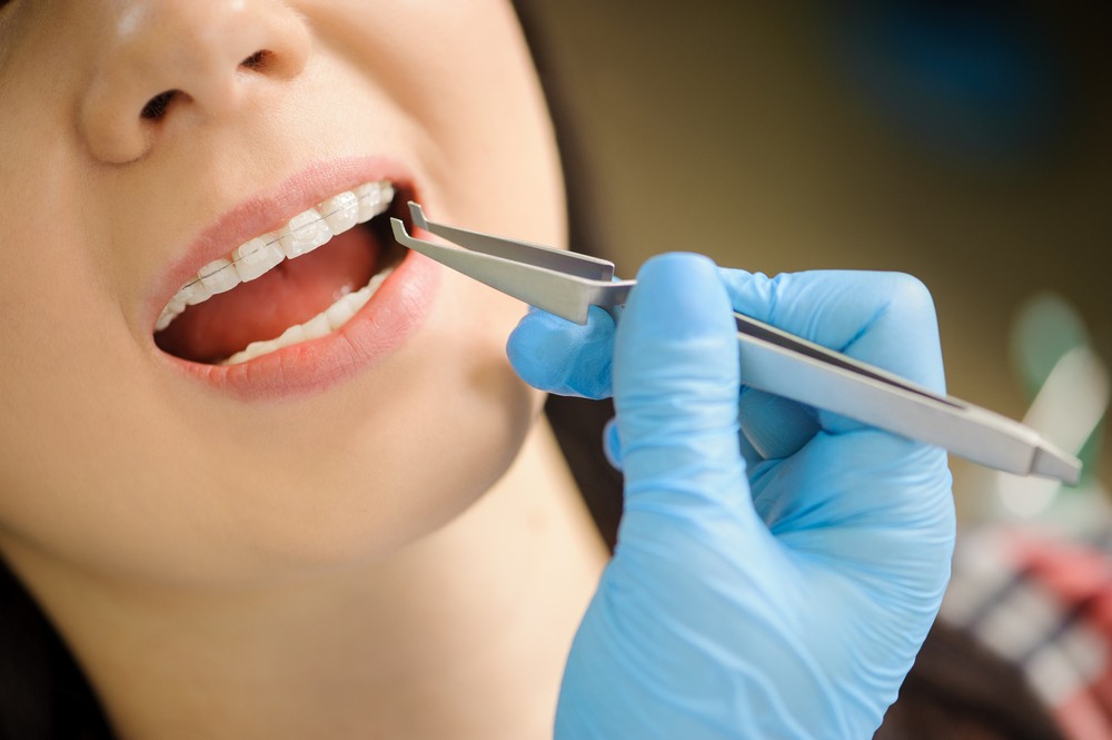 aparat dentar metalic bucuresti, aparat dentar mobil bucuresti, aparat dentar safir bucuresti