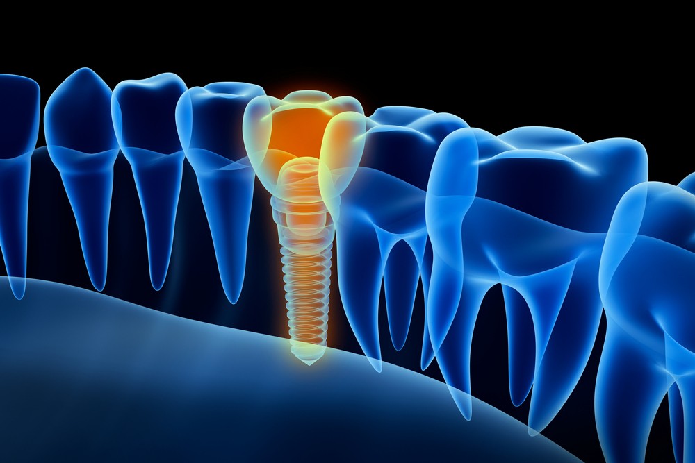 implant dentar bucuresti, implant dentar orto care, implant dentar vitan, implant dentar, orto care