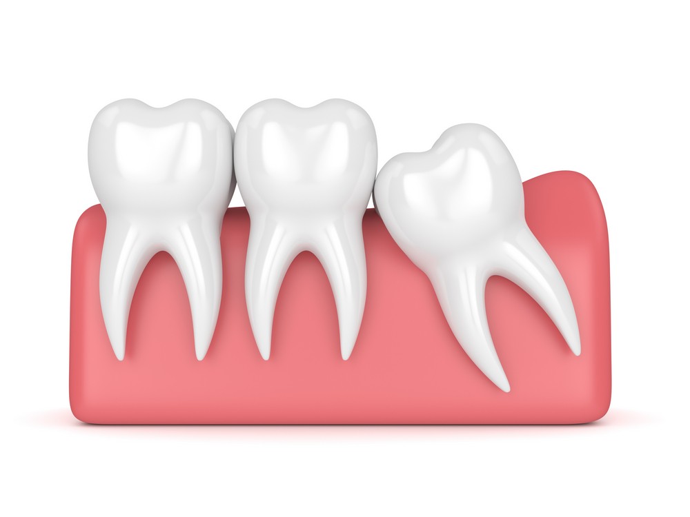 extractie masea de mintebucuresti, extractie molar de minte bucuresti, orto care