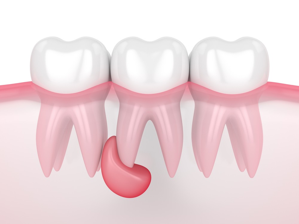 tratament endodontic, obturatie de canal, orto care, stomatologie bucuresti, stomatologie vitan