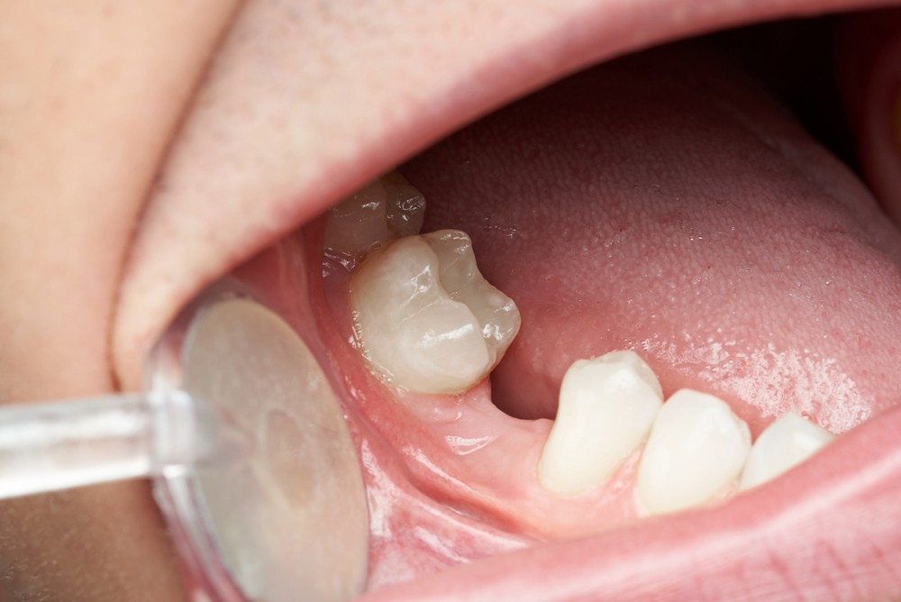 protetica dentara orto care, coroane dentare, coroane dentare bucresti, protetica dentara bucuresti