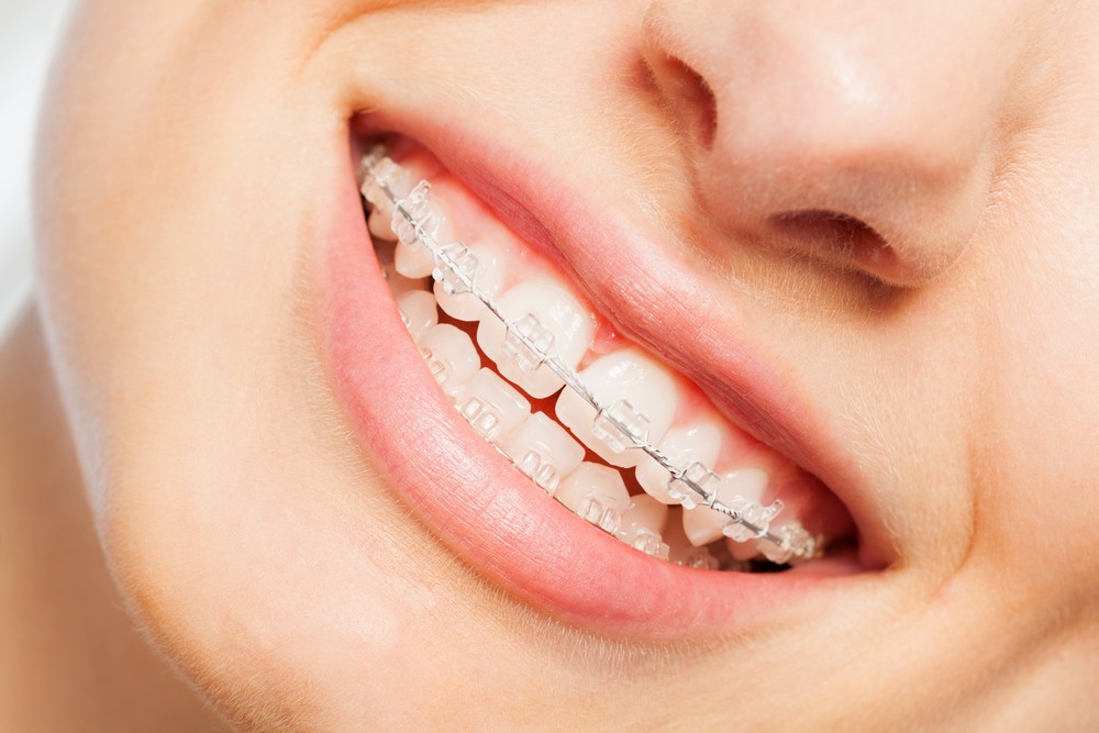 aparat dentar mobil bucuresti, aparat dentar fix bucuresti, aparat dentar metalic bucuresti