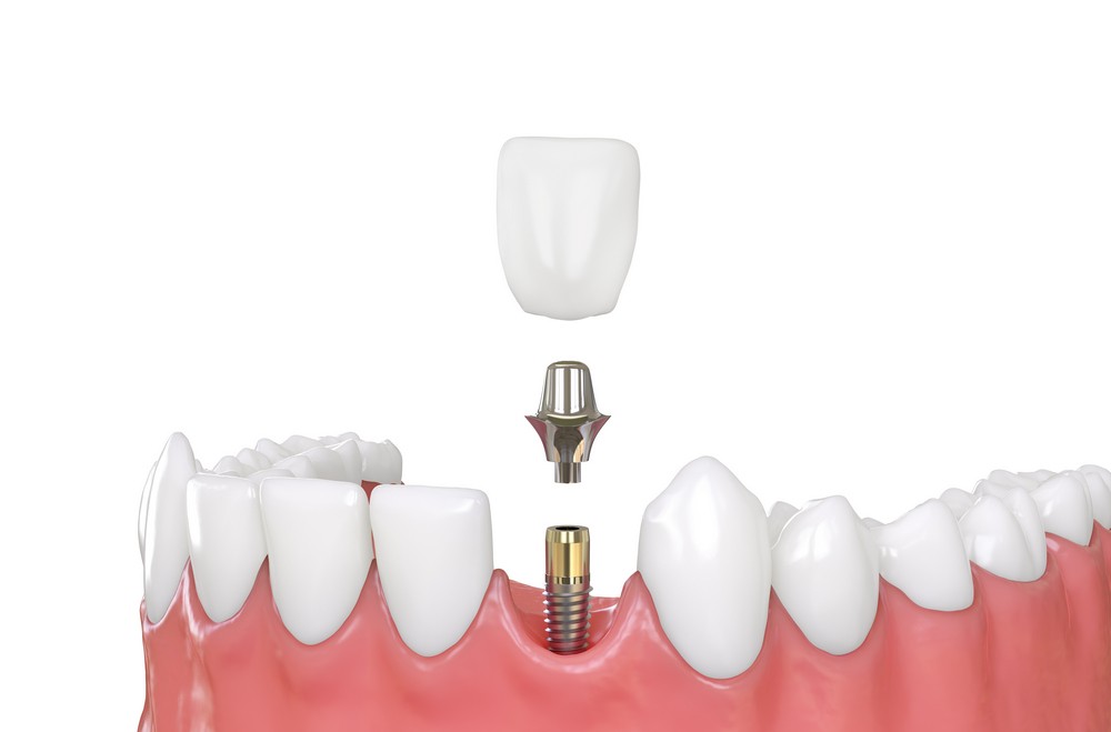 implant dentar bucuresti, implant dentar orto care, implant dentar vitan, implant dentar, orto care